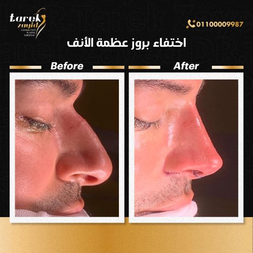 افضل دكتور تجميل انف في مصر 2026